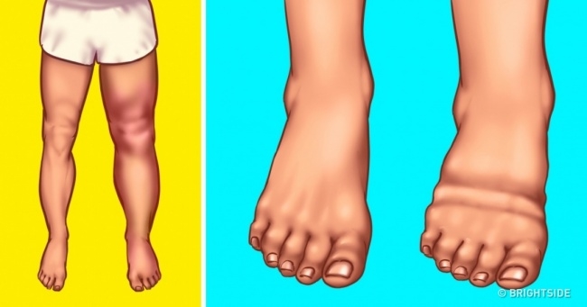 Sưng phù do uống rượu