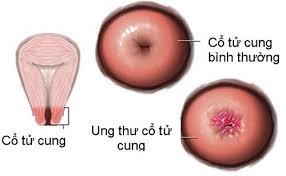 Dịch âm đạo – dấu hiệu chỉ điểm bệnh phụ nữ