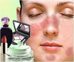 Làm gì khi bị dị ứng mỹ phẩm?