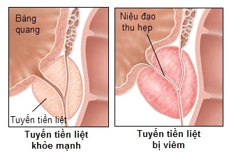 Viêm tuyến tiền liệt: Nguyên nhân, triệu chứng, chẩn đoán và điều trị