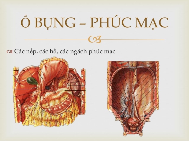 Viêm phúc mạc cấp