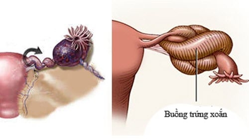 Những người có nguy cơ mắc xoắn buồng trứng?