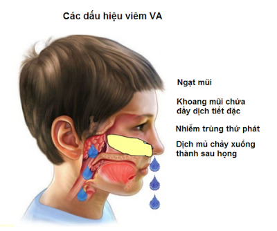 Bệnh viêm V.A mạn tính