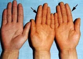 Cách phát hiện bệnh vàng da ở trẻ sơ sinh cha mẹ cần chú ý