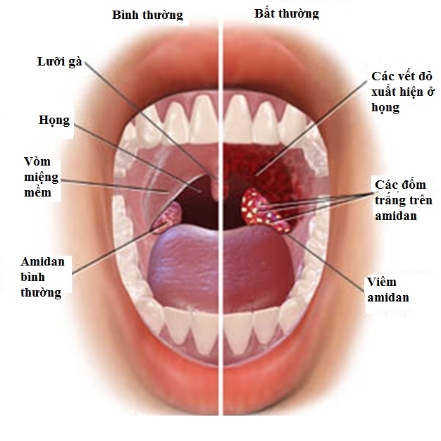 Ðau một bên họng - Vì sao?