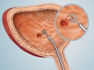 Chủ động chặn nhiễm trùng bàng quang