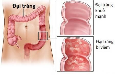 Các giai đoạn ung thư đại tràng