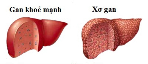 Dấu hiệu bệnh gan do rượu