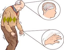 Bấm huyệt chữa PARKINSON theo phương pháp phản xạ (P.1) - Thầy Lê Phương Cảo