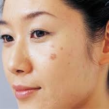 Cách hạn chế đồi mồi trên da