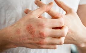 Bệnh chàm nên ăn kiêng những gì?