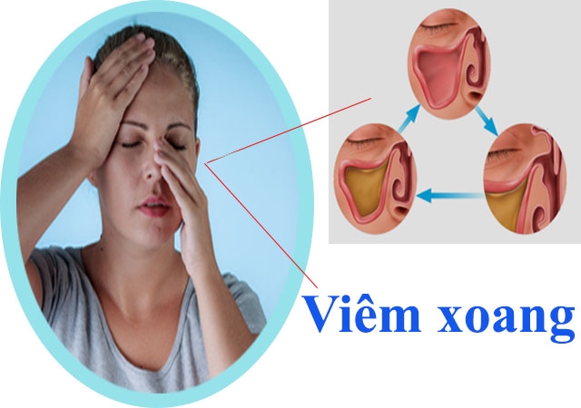 Bệnh viêm mũi-xoang và những điều cần biết