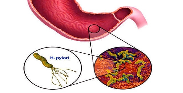 Vi khuẩn HP gây viêm dạ dày, ung thư dạ dày đáng sợ mức nào?