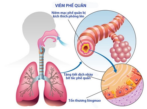 Bệnh đường hô hấp dễ mắc trong mùa nóng: Các biện pháp phòng ngừa