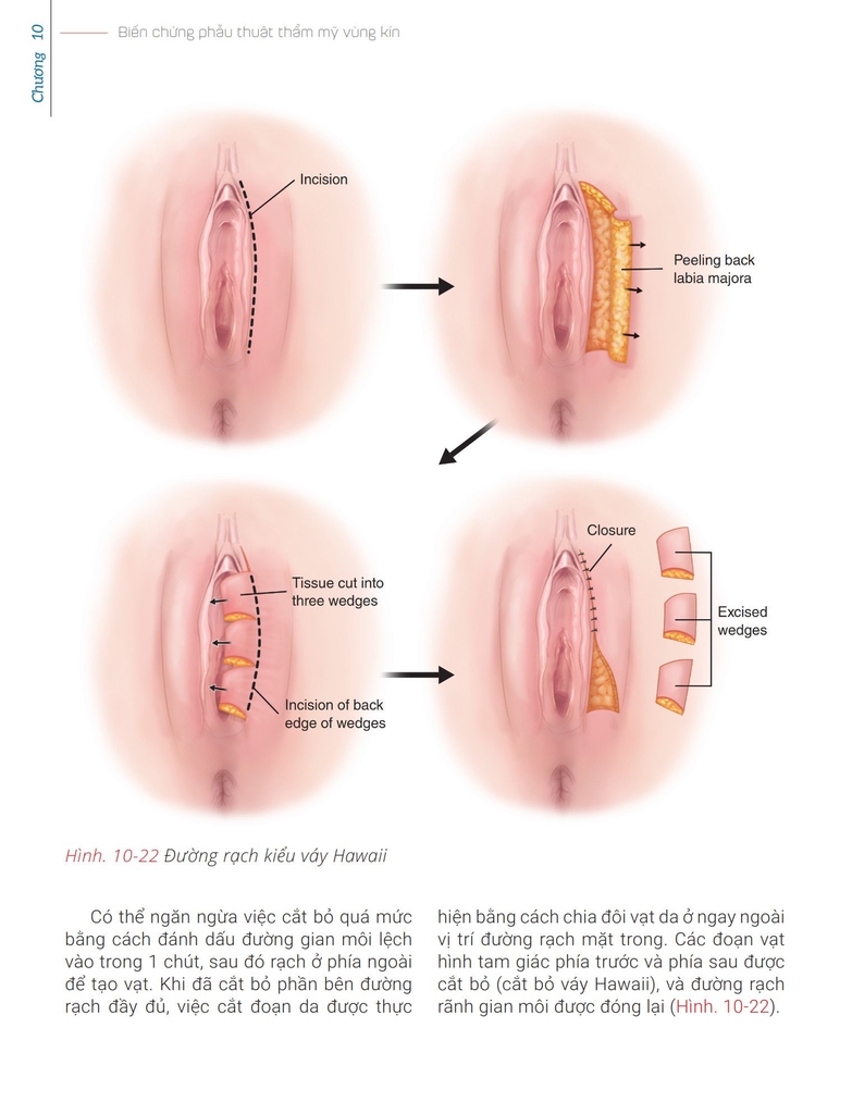 Sách phẫu thuật thẩm mỹ vùng kín