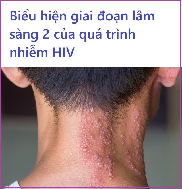 Giai đoạn lâm sàng 2 của HIV có biểu hiện gì?
