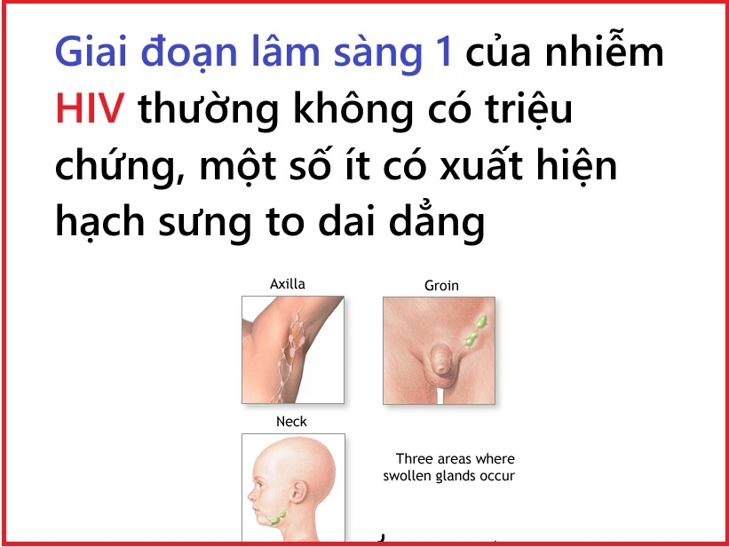Biểu hiện của nhiễm HIV giai đoạn lâm sàng 1 là gì?