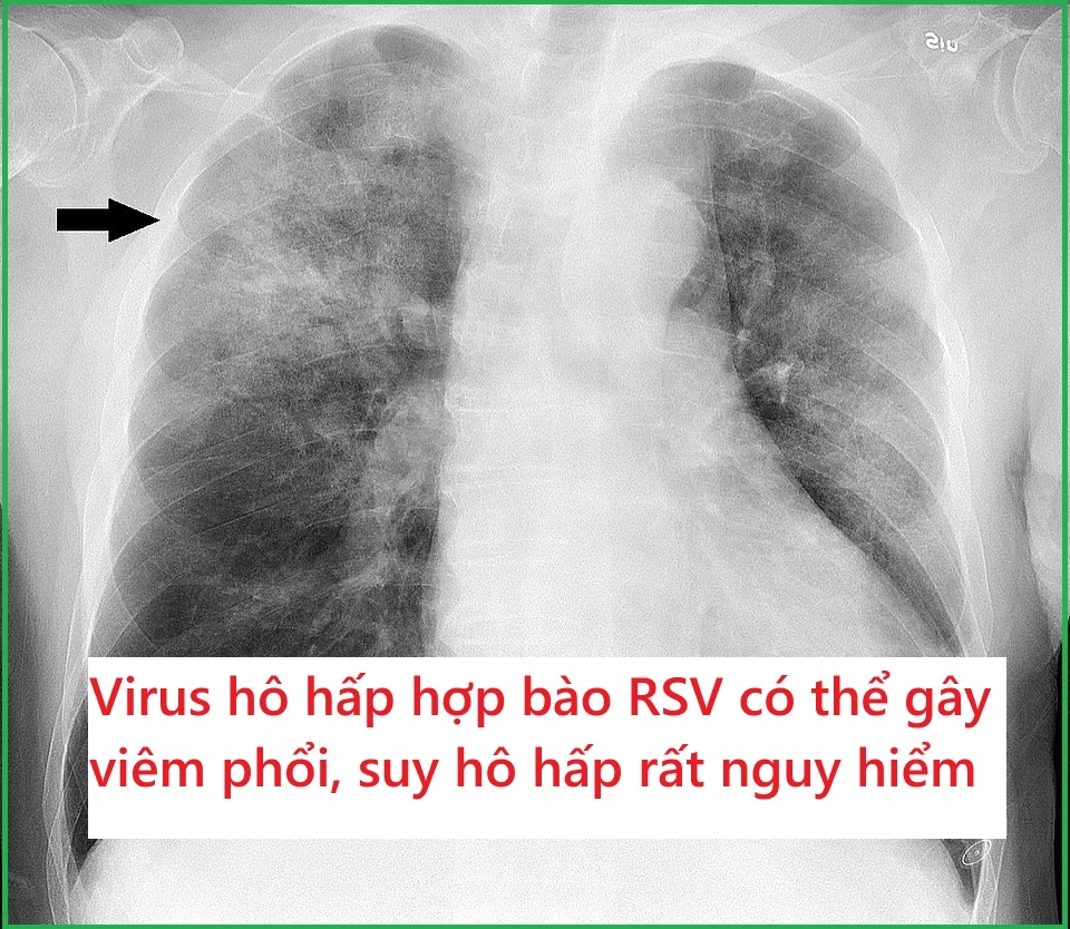 Virus hô hấp hợp bào có thể gây ra biến chứng gì? Cách điều trị và phòng ngừa?