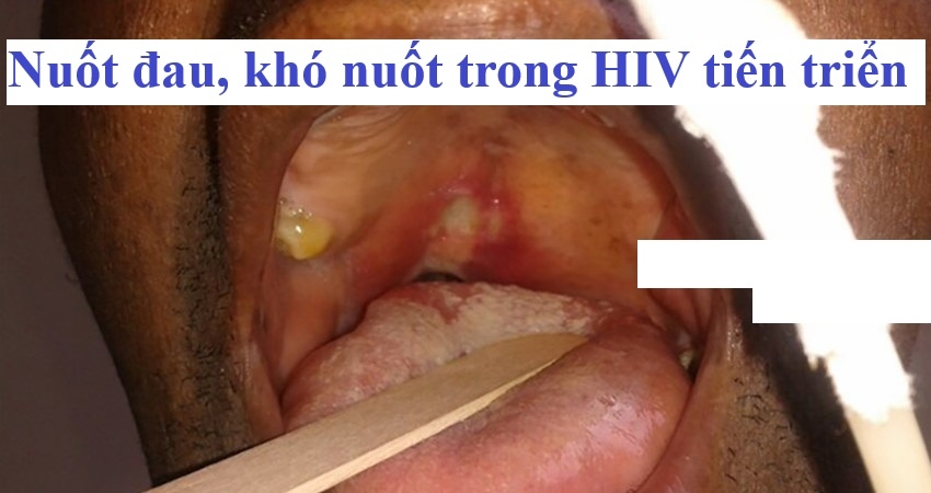 Rối loạn về nuốt và tiêu hóa trong bệnh HIV tiến triển?