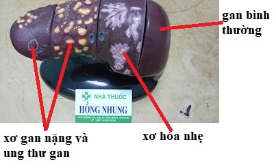 DIỄN TIẾN TỰ NHIÊN THEO 4 GIAI ĐOẠN CỦA NHIỄM VIRUS VIÊM GAN B (HBV) MẠN TÍNH - CẬP NHẬT KIẾN THỨC VIÊM GAN B TỐT NHẤT Ở TPHCM (SÀI GÒN)