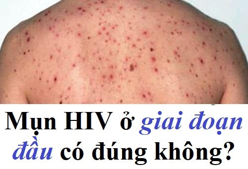 Nổi mụn HIV ở giai đoạn đầu đúng không?