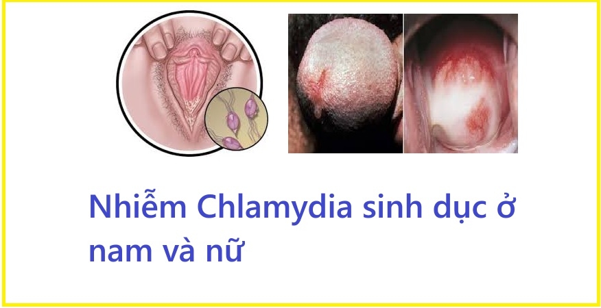 Chẩn đoán và điều trị nhiễm Chlamydia như thế nào?