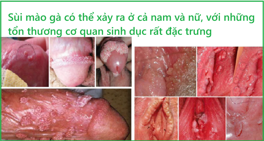 Chẩn đoán và điều trị sùi mào gà sinh dục hậu môn như thế nào?
