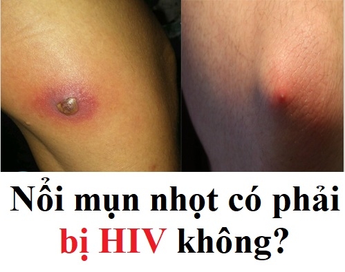 Nổi mụn nhọt có phải bị HIV không?