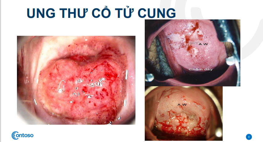 Cần chú ý bệnh ung thư cổ tử cung ở phụ nữ nhiễm HIV