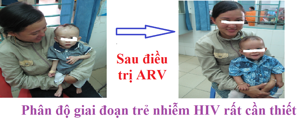 Phân độ giai đoạn nhiễm HIV ở trẻ em có ý nghĩa rất quan trọng