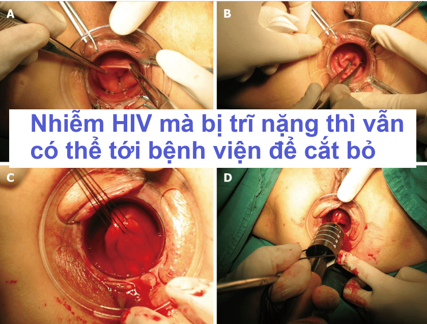 Nhiễm HIV mà bị trĩ có đi cắt được không?