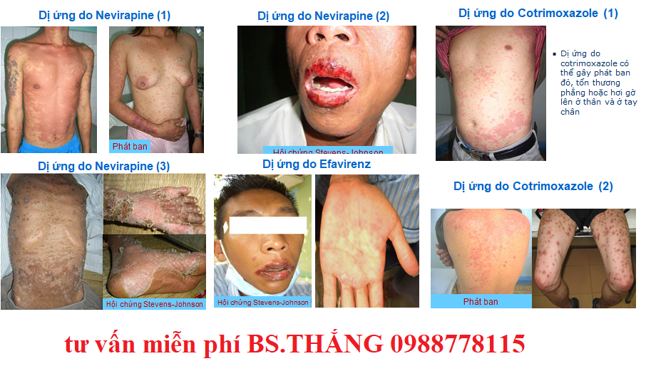 Tác dụng phụ của thuốc ARV đáng sợ như thế nào?