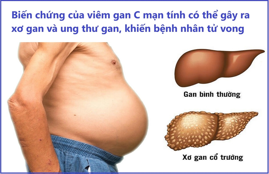 Viêm gan C là gì? Biến chứng của viêm gan C?