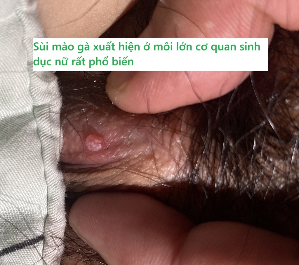 Cảnh báo tình trạng mắc bệnh sùi mào gà đang gia tăng trong giới trẻ