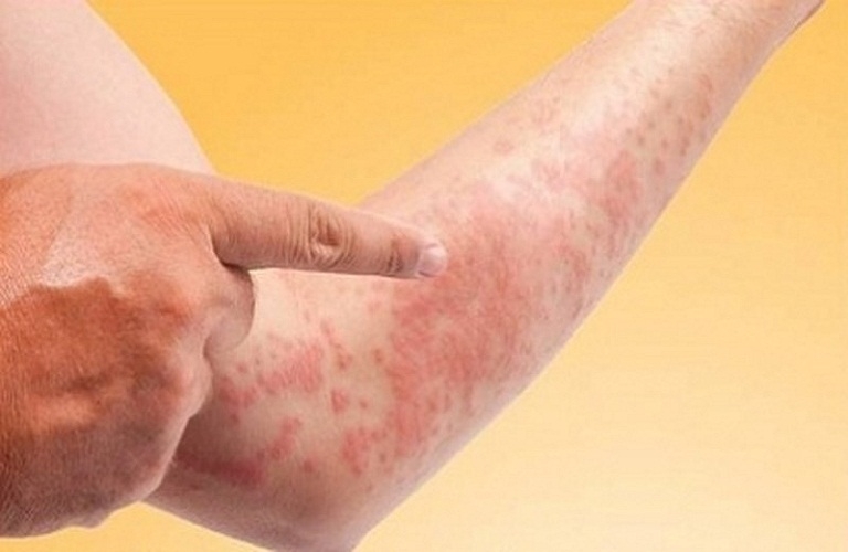 CÁC BỆNH NGOÀI DA Ở NGƯỜI LỚN THƯỜNG GẶP