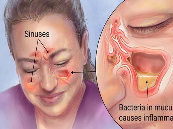 Những triệu chứng điển hình của viêm xoang