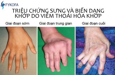 viem-thoai-hoa-khop-dinh-nghia-dich-te-nguyen-nhan-trieu-chung-lam-sang