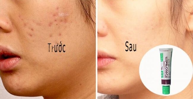 Gel Trị Sẹo Gentacin 0.1% 10G (Cây)