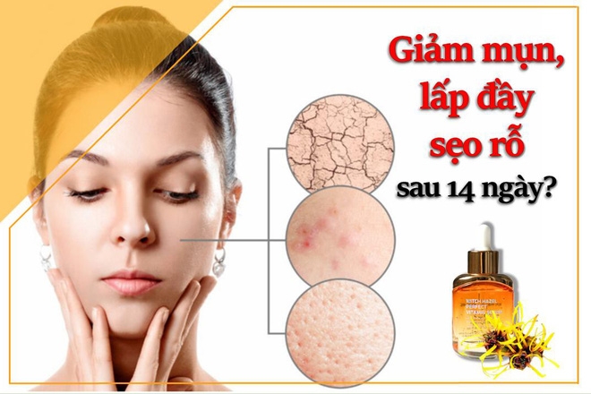 Tinh Chất Derladie Witch Hazel Perfect Vitamin Giảm Mụn, Hỗ Trợ Làm Mờ Sẹo (Mới) 35ml