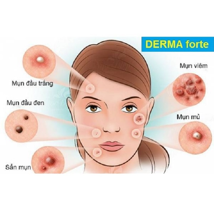 Gel Trị Mụn Derma Forte 15g