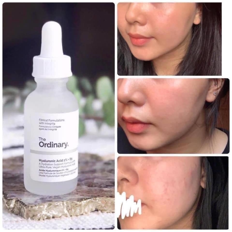 Tinh Chất The Ordinary Niacinamide 10% + Zinc 1% 30ml