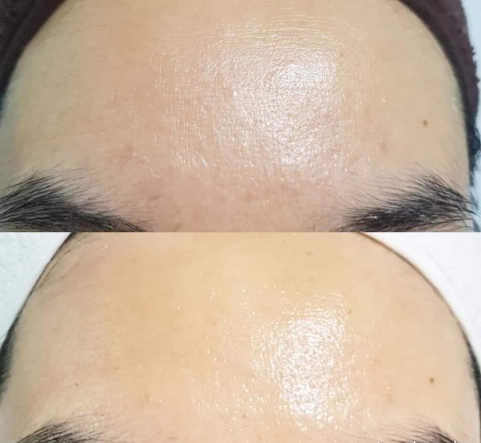 Microneedling - Dập trắng sáng da Radiance