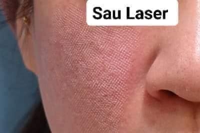 Laser CO2 - Giải Pháp Tối Ưu Cho Trẻ Hóa, Thu Nhỏ Lỗ Chân Lông, Tái Cấu Trúc Da