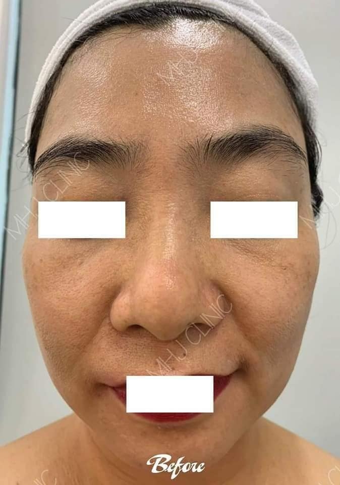 HIFU - Lựa Chọn Số 1 Tại MHJ Clinic Cho Thon Gọn Trẻ Hóa Da Không Phẫu Thuật