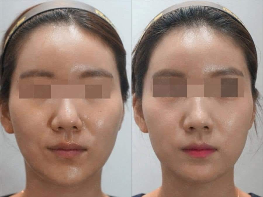 HIFU - Lựa Chọn Số 1 Tại MHJ Clinic Cho Thon Gọn Trẻ Hóa Da Không Phẫu Thuật