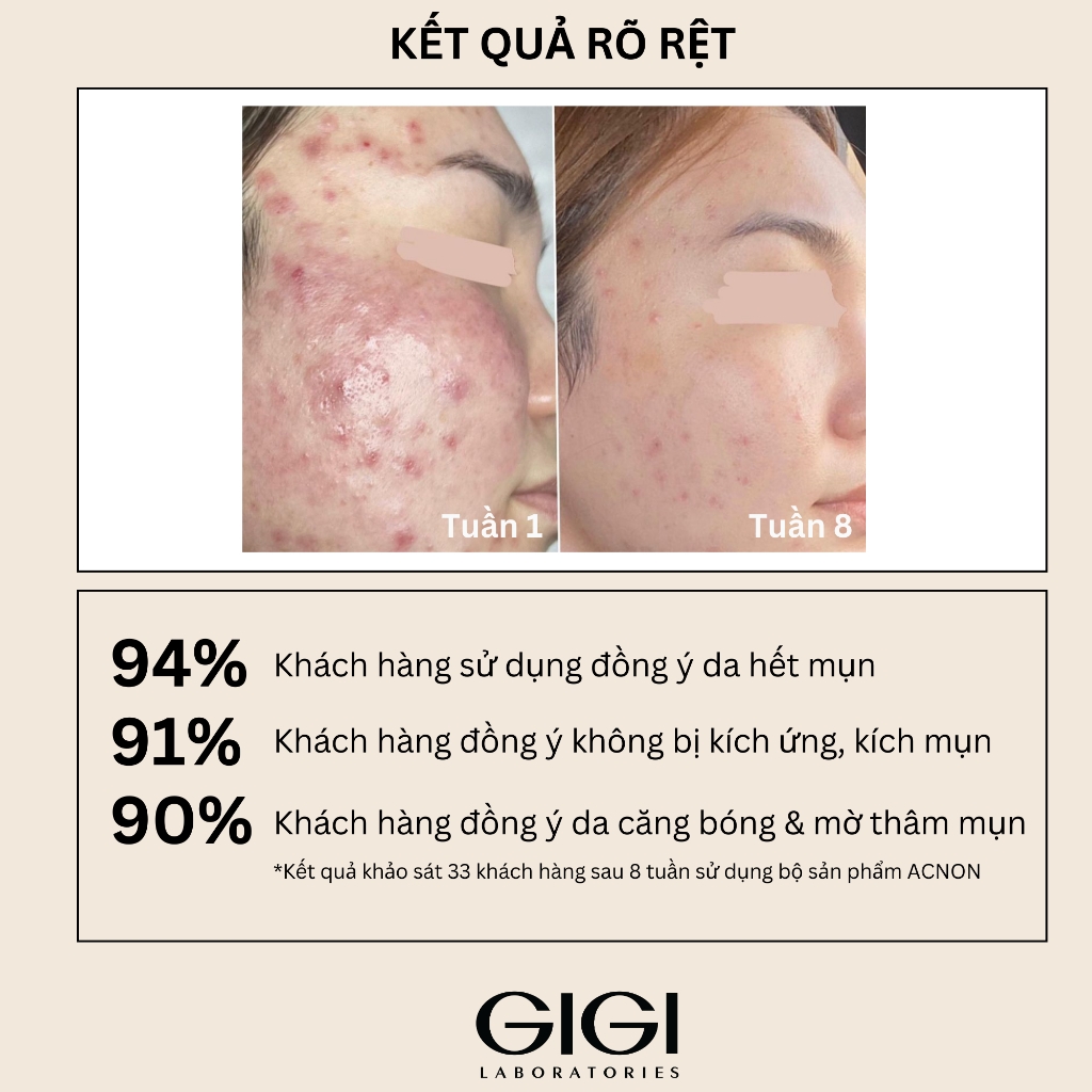 Kem đêm trị mụn GIGI ACNON OVERNIGHT TREATMENT 50ml