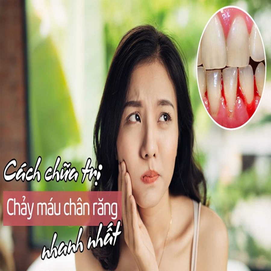 Chảy máu chân răng thường xuyên là bệnh gì? 