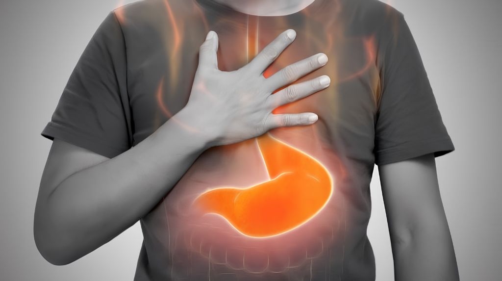 Trào ngược dạ dày kèm ợ nóng