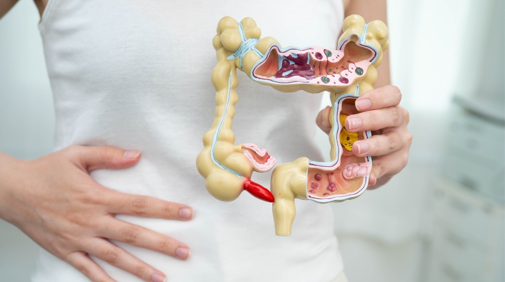 Viêm đại tràng là tình trạng lớp niêm mạc bên trong đại tràng bị viêm