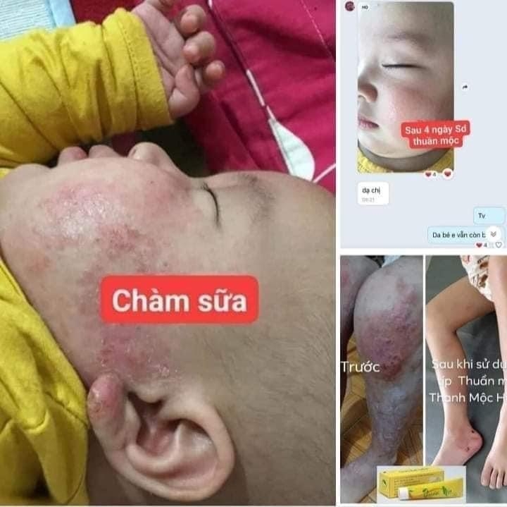 KEM BÔI HỖ TRỢ GIẢM BỆNH NGOÀI DA, THUẦN MỘC XỊN (10) '